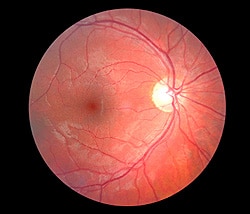 retinal 000004418726xsmall