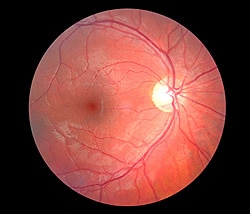 retinal 000004418726xsmall